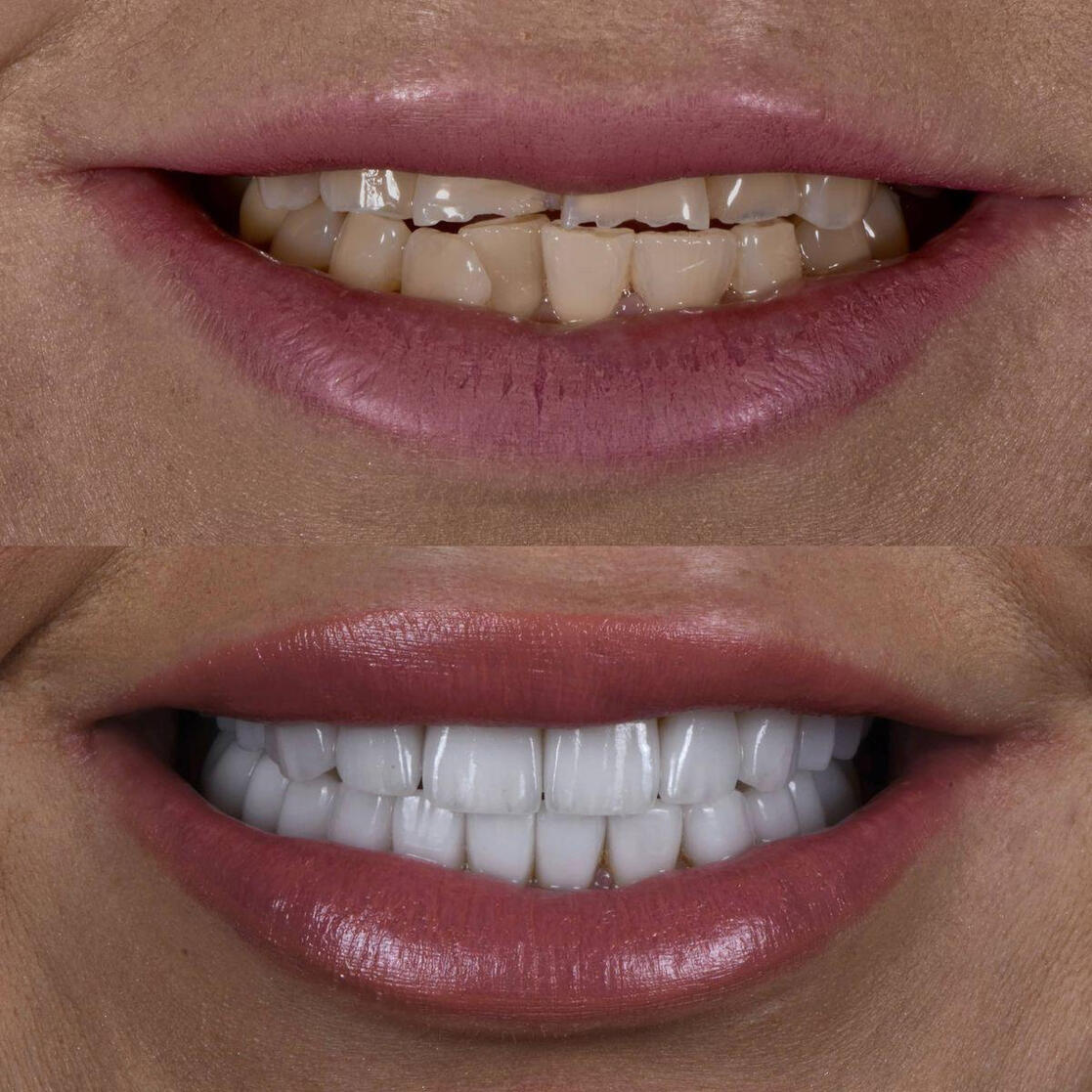 Rezultate care îmbină estetica, funcționalitatea și naturalețea. Rezultate care îmbină estetica, funcționalitatea și naturalețea.